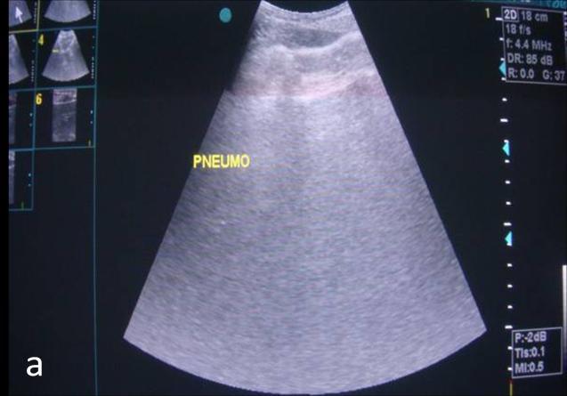 Figure 4 a &b: Ultrasound of upper abdomen showing enhancement of peritoneal stripe with distal reverberations suggestive of pneumoperitoneum.
