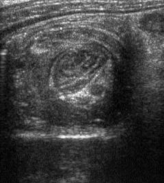 Ultrasound for Intussusception