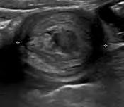 Intussusception Small amounts are common