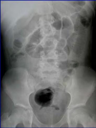 Perforated Appendix Dilated small