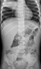 Non-GI Causes of Abdominal Pain 5 yr old with abdominal pain, fever, and vomiting Hospital 1 Abdominal US Hospital 2 Abdominal US Abdomen MRI All normal.