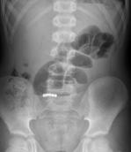 Abdominal Radiographs (Get No Respect) Can be diagnostic When not diagnostic, can provide useful