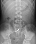 beads Duodenal web XR Non-diagnostic Normal or findings of proximal obstruction Fluoroscopy bilious