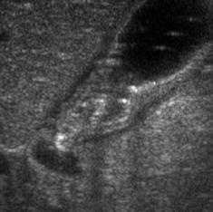 weeks of age Normal Pylorus 1-2 mm
