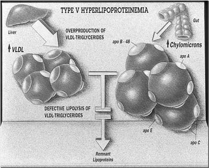 VLDL VLDL VLDL and Chylo Remnant FFA Insulin Hypertriglyceridemia: A risk factor for atherosclerosis VLDL can enter