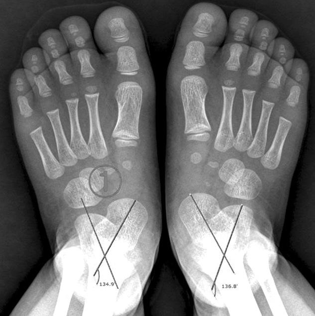 the inferior border of the calcaneus and the baseline on a lateral radiograph. The baseline was defined as the connection of the closest point of the first metatarsus and calcaneus on the floor (Fig.