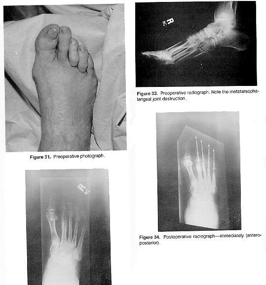 asymptomatic. This weight bearing photograph illustrates good cosmesis obtained from this incisional approach.