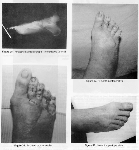 and 35 and the 1-week postoperative photograph Fig. 36). Figures 37 and 38 represent 1-month and 5-month follow-up photographs of the patient's right foot (Fig's 39, 40).