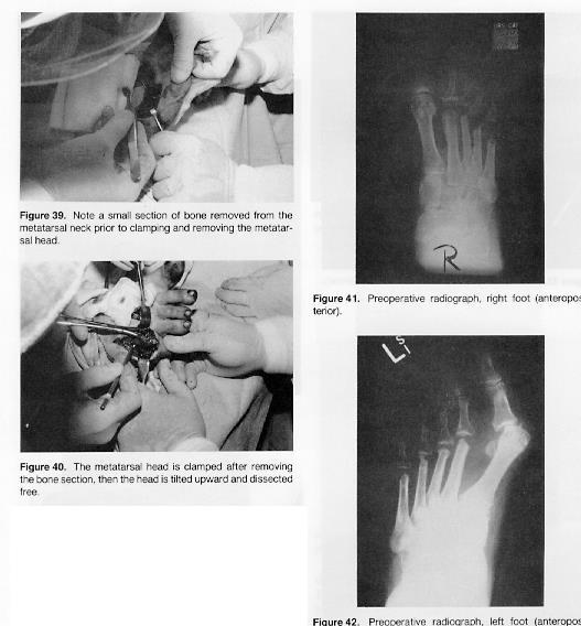bilaterial metatarsophalangeal joint destructive procedures. Figure 41 represents the postoperative photograph of both feet. Keller arthroplasty was performed on the right foot.