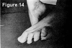 Figures 14 and 15 are the preoperative photographs of a 39 year old rheumatoid arthritic female.
