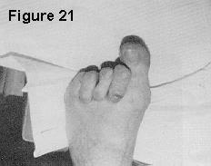 maximum exposure and visualization for intraoperative decisions. Figure 19is a 3week postoperative photograph.
