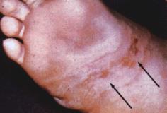 Most common skin dz in travelers to tropics Larvae of dog hookworm (Ancystoloma braziliense) Soil, sand contact Rx topical thiabendazole, PO ivermectin Syndrome: