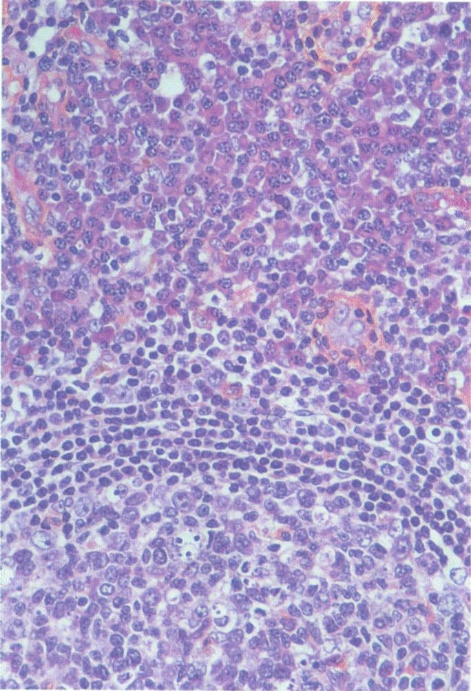 Lymph node with plasma cell