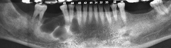 However, only a few cases of a hybrid lesion containing characteristics of both odontogenic keratocyst and CGCG have been reported, indicating that the present case is rare and therefore of