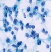 » Children and young adults benign lymphadenopathy more common; higher