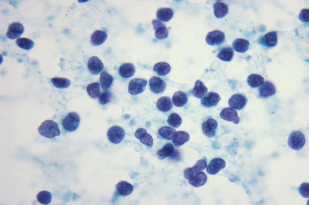 Rosai Dorfman Disease Esp in young children & adolescents Bilateral cervical lymphadenopathy Fever, joint pain, night sweats Labs: Polyclonal hypergammaglobulinemia; leukocytosis Cytology: