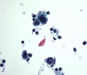FNA of Classical Hodgkin Lymphoma: RS Cells Pitfall: A