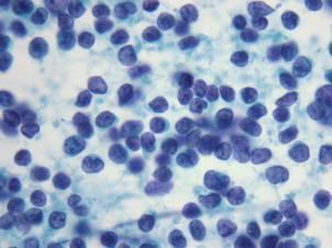 Diagnosing NH Lymphomas by FNA How do we distinguish the different small cell lymphomas?
