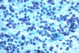 cells Plasma cells Follicular dendritic cells, tingible-body macrophages, reactive immunoblasts, follicular aggregates Lymphoepithelial lesions (MALT) CD5-, CD10-, Bcl-6-,
