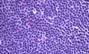 prolymphocytes and paraimmunoblasts Rare/absent TBM and follicular aggregates CD5+,CD23+, CD10- is characteristic CD5, CD20, LC are usually dim or weak Trisomy 12 (30%),