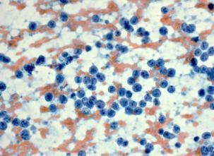 lymphoma/poor prognosis 3-5 yr median survival 3-10% of NHL; adults >50 yrs; M>F Commonly extranodal Monomorphous small to imtermediate lymphs Fine chromatin Indistinct