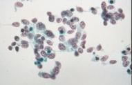 Respiratory compromise Upper body lymphadenopathy FNA is highly accurate!