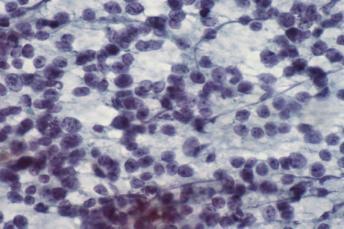 HPV+ SCC Cystic SCC Met Nasopharyngeal