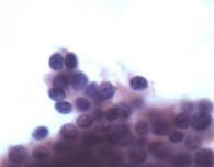 follicular rather than paracortical hyperplasia Cytology:» Wide variety of cell
