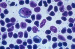 Cytology of Reactive Lymphoid Hyperplasia Cytologic findings Variety of cell types: