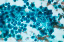 predominate Plasmacytoid lymphocytes Centrocytes Centroblasts Immunoblasts