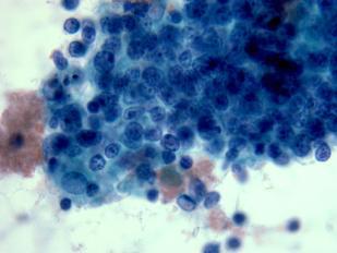 lymphocytes (Mixed B & T cells)