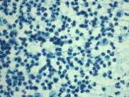 Multinucleated giant cells Lymphocytes Clean background Hypocellular aspirate in late phase Fungal or