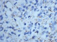 Lymphadenitis Submit material for cultures Acute bacterial lymphadenitis Cellular Abundant neutrophils