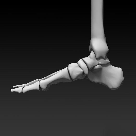 10 NEOFIT - SURGICAL TECHNIQUE (3/7) 3 - ADJUSTMENT OF THE ARTHRODESIS Adjustment of the arthrodesis