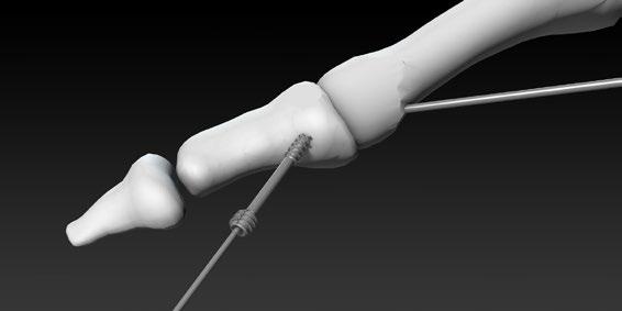 11 NEOFIT - SURGICAL TECHNIQUE (4/7) 4 - TRANSFOCAL SCREW 5 - PRESENTATION OF THE IMPLANT NeoFit Left