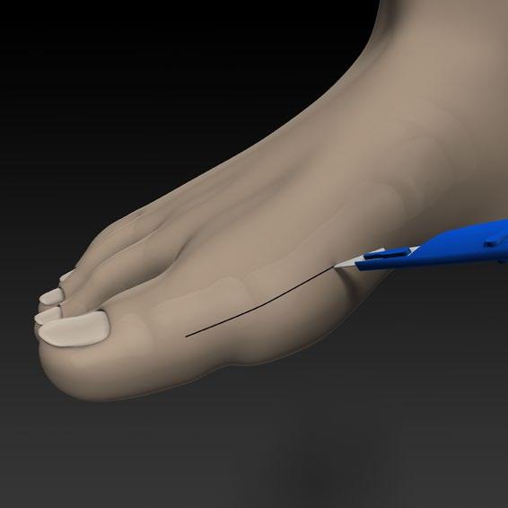 8 NEOFIT - SURGICAL TECHNIQUE (1/7) 1 - INCISION The incision is preferentially medial, centred on the metatarsophalangeal (MP1) interline.