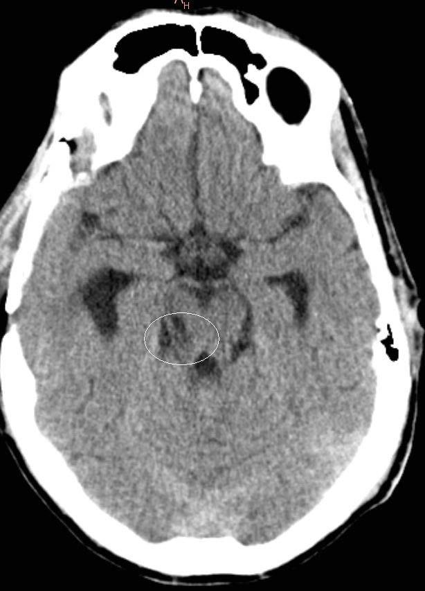 Ipsilateral 3 rd nerve palsy Midbrain stroke Contralateral hemiparesis of