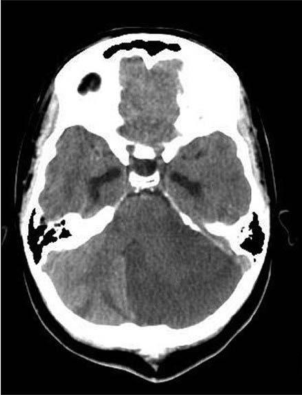 Cerebellar infarction Infarction causes edema resulting in mass effect, herniation and compression of the fourth ventricle