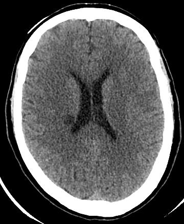 Lacunar stroke syndromes Ataxic hemiparesis often arises from infarction in the