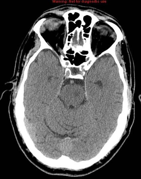 Lacunar stroke syndromes Clumsy hand-dysarthria is caused by infarction in the pons, but can also occur in corona radiata and the internal capsule