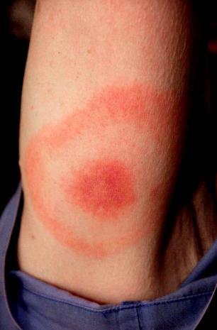 Erythema Migrans (EM) Seen in ~ 70-80% of cases ~1-2 weeks after tick