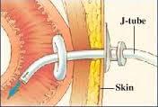 J-tube (jejunum) Tube bypasses the