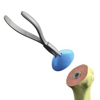 Option 1: Soft-Tissue Balancing Approach The SIMPLICITI STB system was designed to offer surgeons intra-operative flexibility when treating diseased and deformed anatomy.