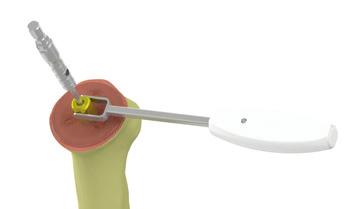 (Figure 5) Figure 5 Choose the largest sizer that does not overhang the humerus at any point.