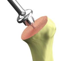 (Figure 8) Figure 8 Before initiating power, place the planer flat on the humeral cut and assess the planer s fit to the bone.