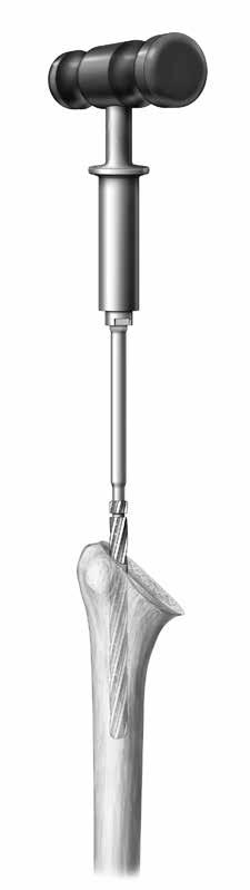 Reaming the Humeral Shaft The smallest Reamer (7mm) has a sharp tip to facilitate the initial entry into the IM canal (Figure 3).