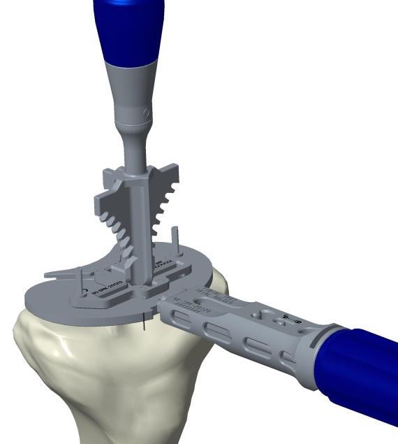 h) Tibial Preparation If using the Keel Punch Guide - Floating, place the Tibial Tray Trial back onto the tibia using the markings on the Trial for orientation.