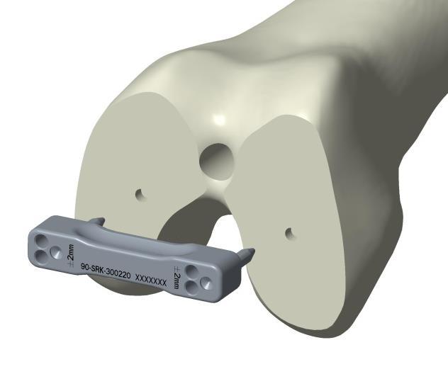 l) Appendix I: A/P Adjustment of Femoral Chamfer Cutting If the position of the 4-in-1 Cutting Block based on the holes drilled through the Femoral Sizer needs to be adjusted, remove the 4-in-1