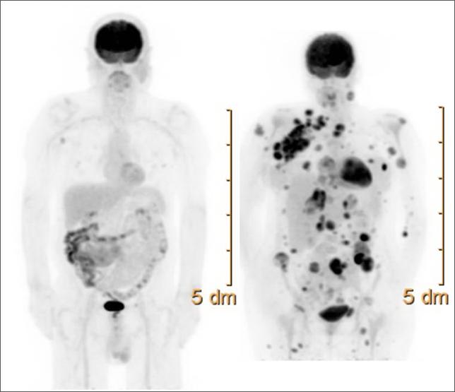 melanoma Disease burden & pace of progression Symptomatic