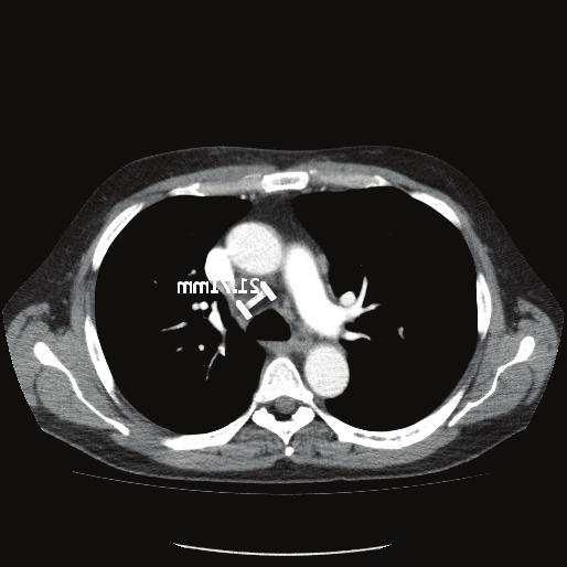 2 Case Reports in Oncological Medicine Figure 1: CT scan (pretreatment) showing lymph nodes. Figure 3: CT scan showing complete remission. Figure 2: CT showing lung lesion before Vemurafenib.